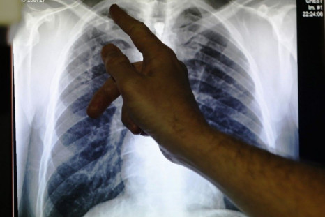 Clinical lead Doctor Al Story points to an x-ray showing a pair of lungs infected with tuberculosis during an interview with Reuters on board the mobile X-ray unit screening for TB in Ladbroke Grove in London, January 27, 2014.