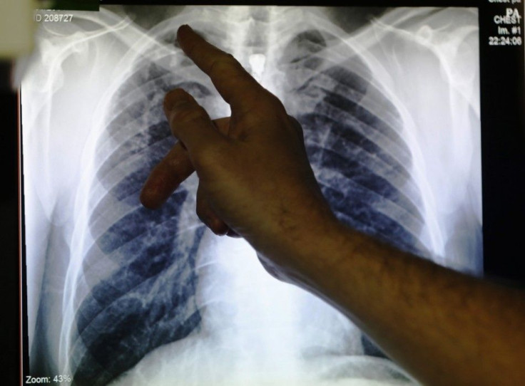 Clinical lead Doctor Al Story points to an x-ray showing a pair of lungs infected with tuberculosis during an interview with Reuters on board the mobile X-ray unit screening for TB in Ladbroke Grove in London, January 27, 2014.