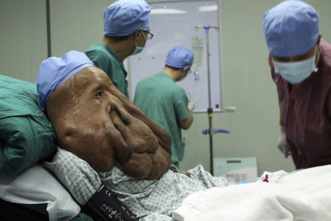 Huang Chuncai, a 37-year-old Hunan province native, lies on a bed as doctors prepare for a surgery to remove tumours from his face at a hospital in Guangzhou, 
