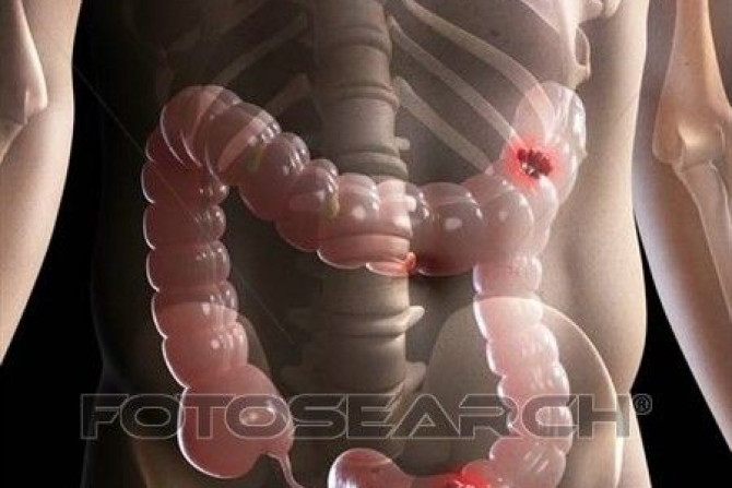 Computerized image of bowel cancer