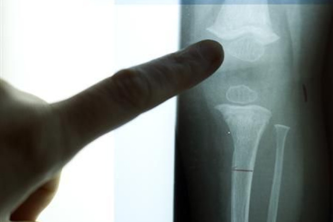 Bone Injury Revealed in An X-ray