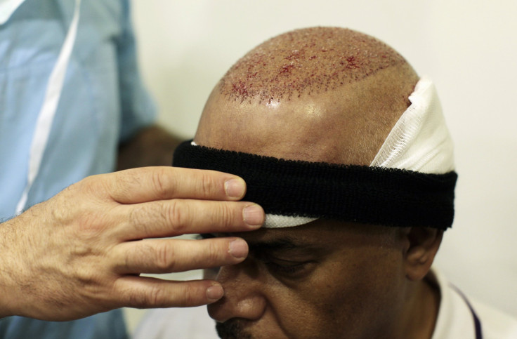 Good bye Baldness; Stem cells to grow new hair- an eye-opener for cell based therapy in hair loss