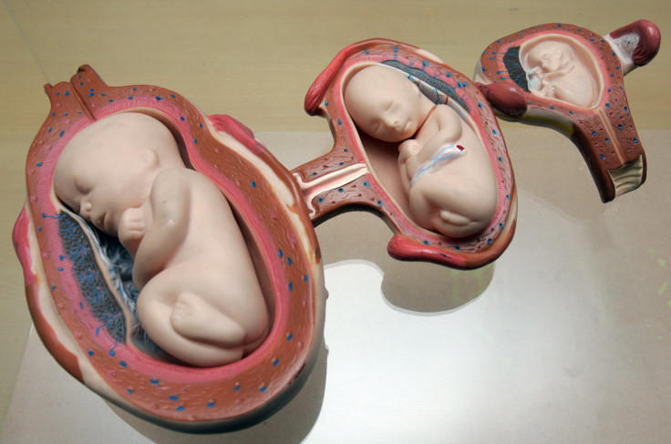 A Baby Girl Born Pregnant With Twins In Hong Kong