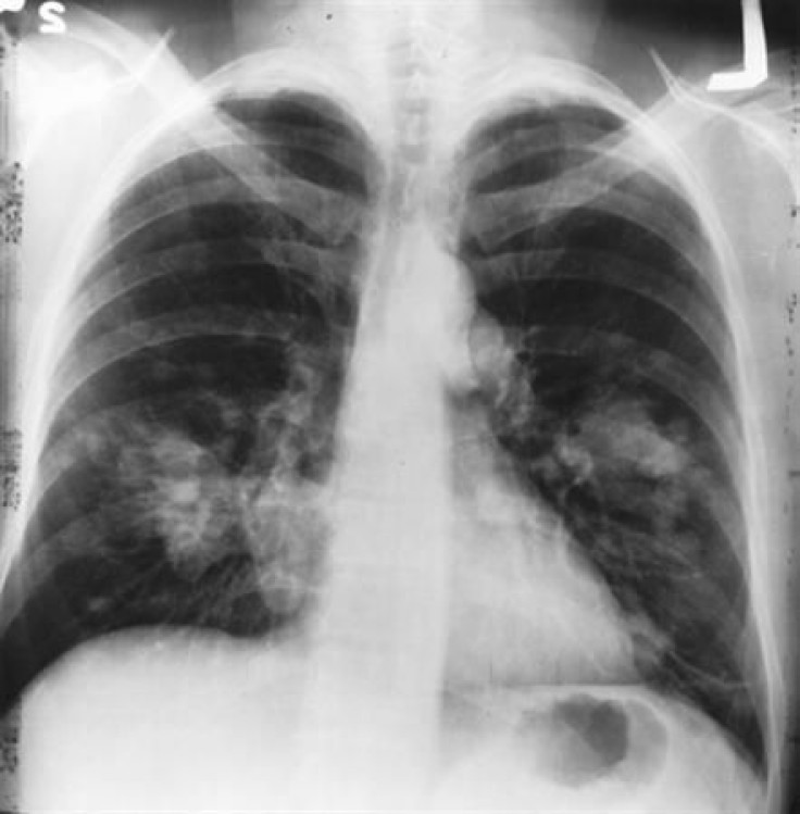 Chest X-ray Showing Cancer