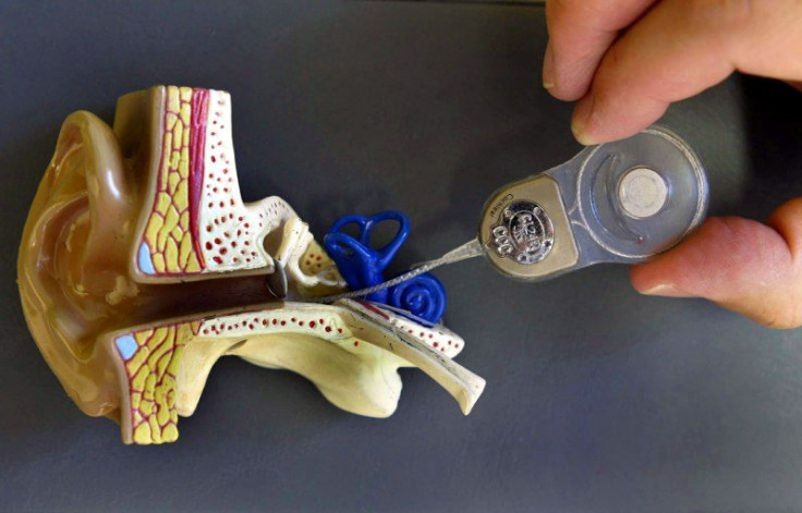 A view of the cochlear implant