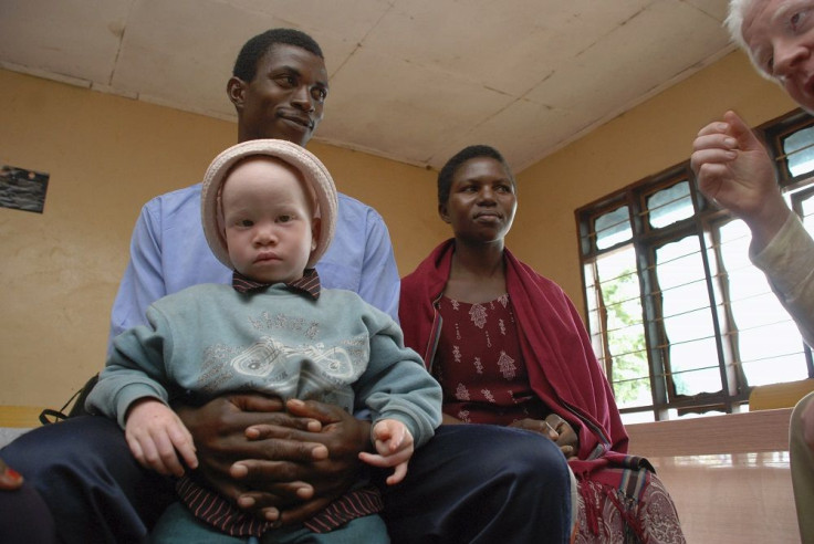 Albino Child in Tanzania