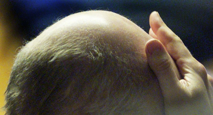 Alopecia