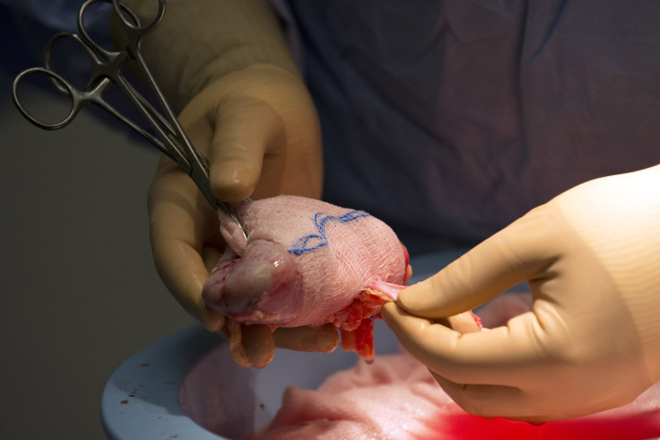 Kidney transplant