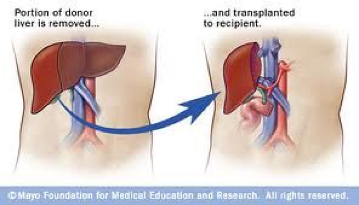 Living Liver Transplant