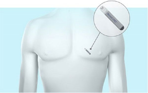 Medtronics Insertable Cardiac Monitor