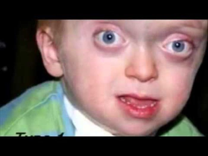 Pfeiffer Syndrome