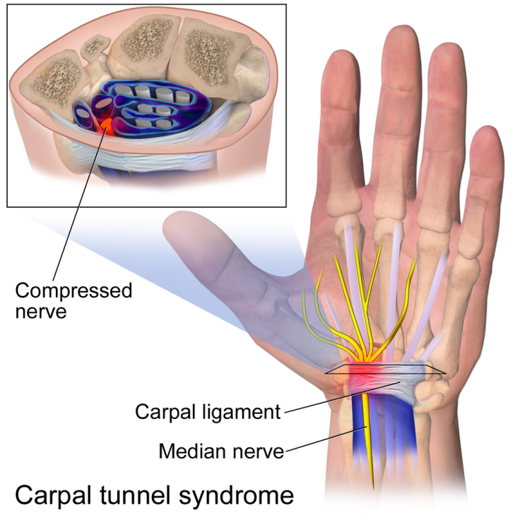 Carpal_Tunnel_Syndrome