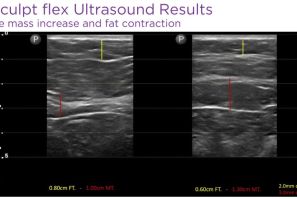 truSculpt flex ultrasound result