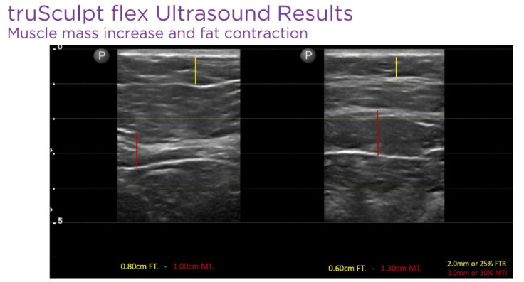 truSculpt flex ultrasound result