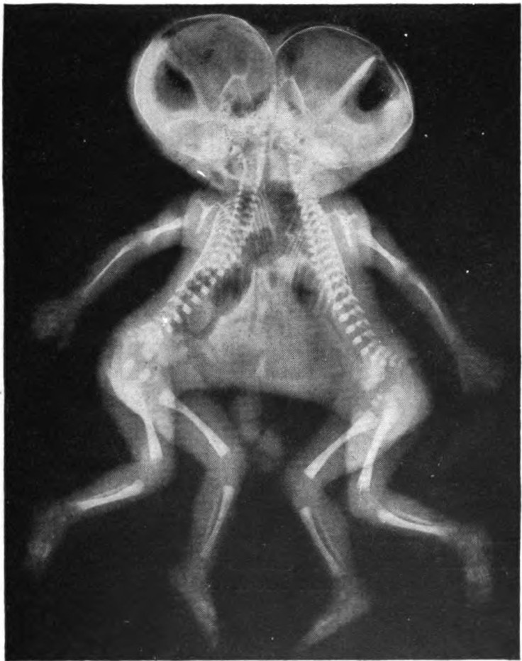 Conjoined twins form when an embryo only partially separates into two and the babies develop connected to each other by the abdomen, chest, pelvis, spine or head.