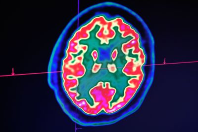 The student thought it was a passing flu until diagnosis proved otherwise. In this image, a picture of a human brain taken by a positron emission tomography scanner, also called PET scan, is seen on a screen at the Regional and University Hospital Center