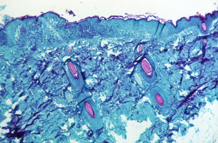 Seattle has recorded the United States' fourth presumptive case of monkeypox. In photo: a section of skin tissue, harvested from a lesion on the skin of a monkey, that had been infected with monkeypox virus, is seen at 50X magnification on day four of ras