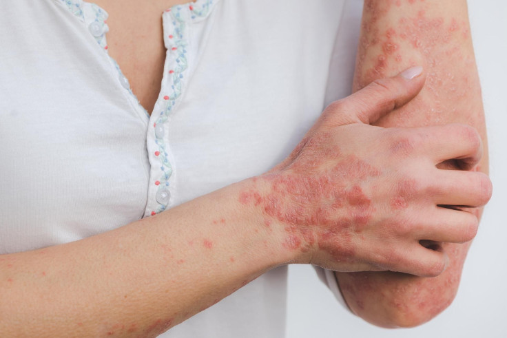 Representation. Psoriasis.