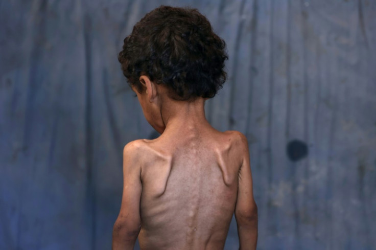 As UN aghecnies warn of imminent mass starvation in Gaza news imgaes of emaciated children have increased pressure on Israel and its US ally to resolve the situation
