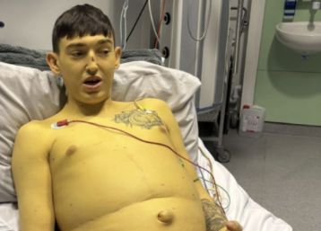 British Man Says Rare Liver Disease Turned His Skin Yellow