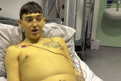 British Man Says Rare Liver Disease Turned His Skin Yellow