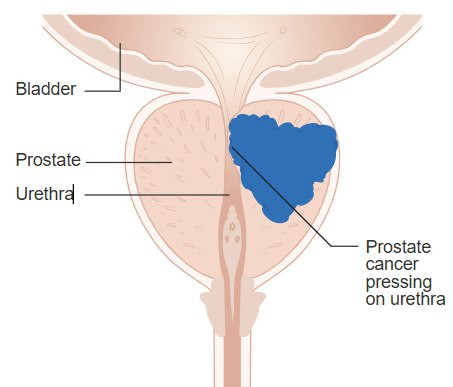 Doctor Explains How Prostate Cancer Screening And Treatment Have Evolved