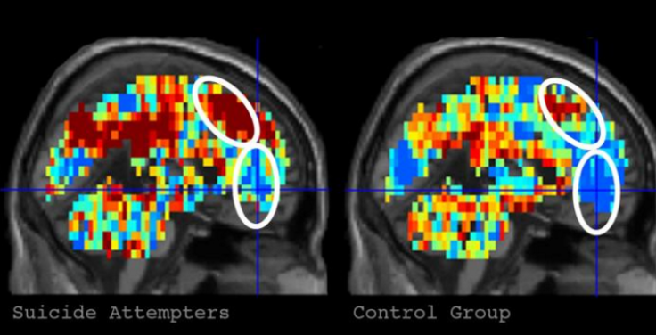 algorithm and brain scan suicide study